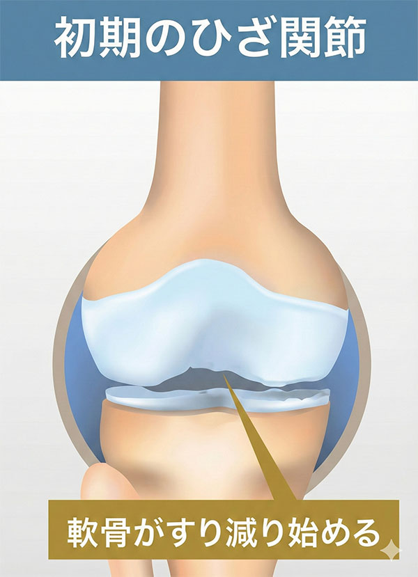 初期のひざ関節のイラスト